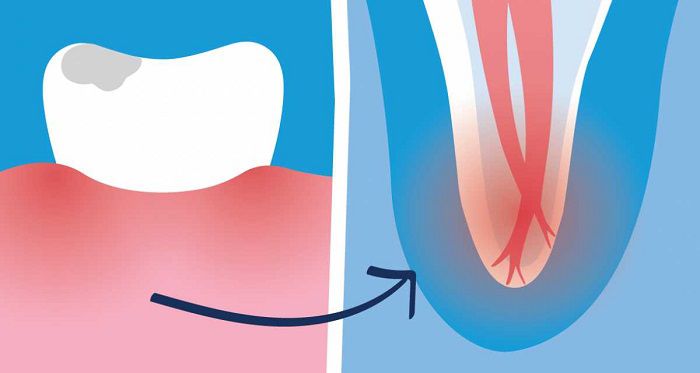 7 Symptoms If You Need A Root Canal For Your Teeth Rc